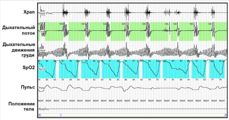 Кардиореспираторное мониторирование дает возможность выявить эпизоды апноэ и нарушений ритма