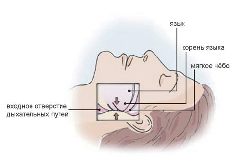 Механизм развития синдрома обструктивного апноэ сна (СОАС)