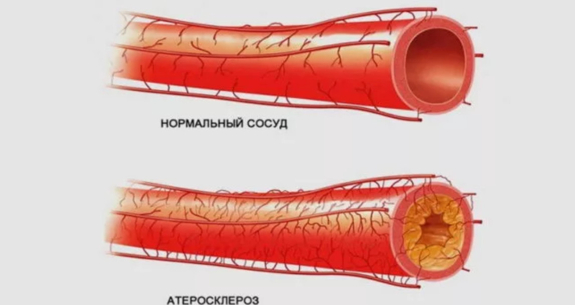 Артериальный сосуд здорового человека и больного диабетом с нарушенным липидным обменом в запущенной стадии