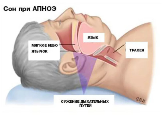 У полного человека во время сна происходит сужение дыхательных путей и может развиваться ночное апноэ