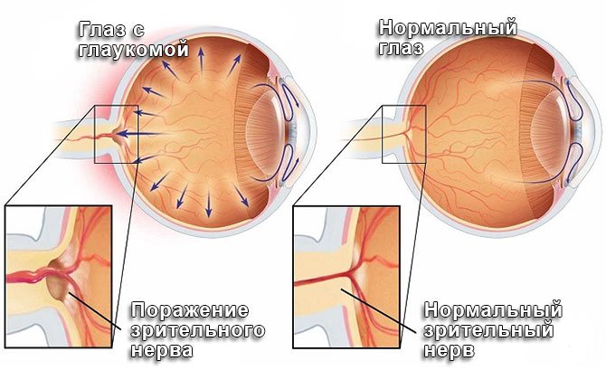 Иллюстрация изменений в глазу при глаукоме