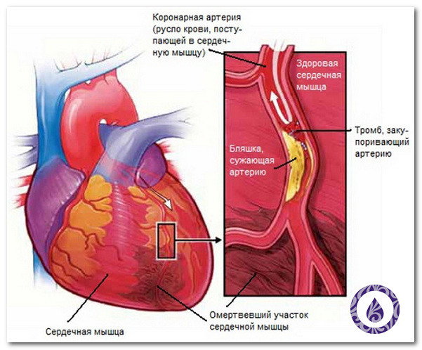 Инфаркт миокарда – некроз клеток сердечной мышцы из-за кислородного голодания