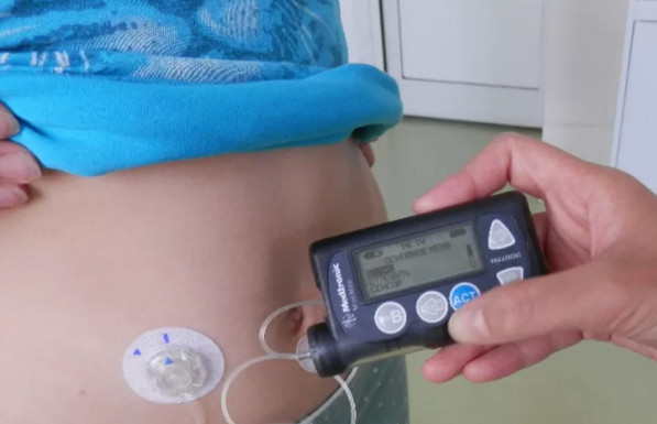Инсулиновая помпа – электронное устройство, позволяющее гибко и плавно регулировать дозу инсулинаа