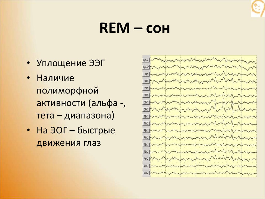 Картина REM-сна на электроэнцефалограмме