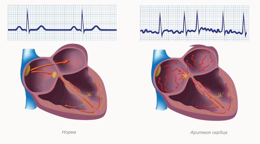 Нарушения сердечного ритма – одна из проблем, с которой пациент с нарушенным сном может обратиться к терапевту