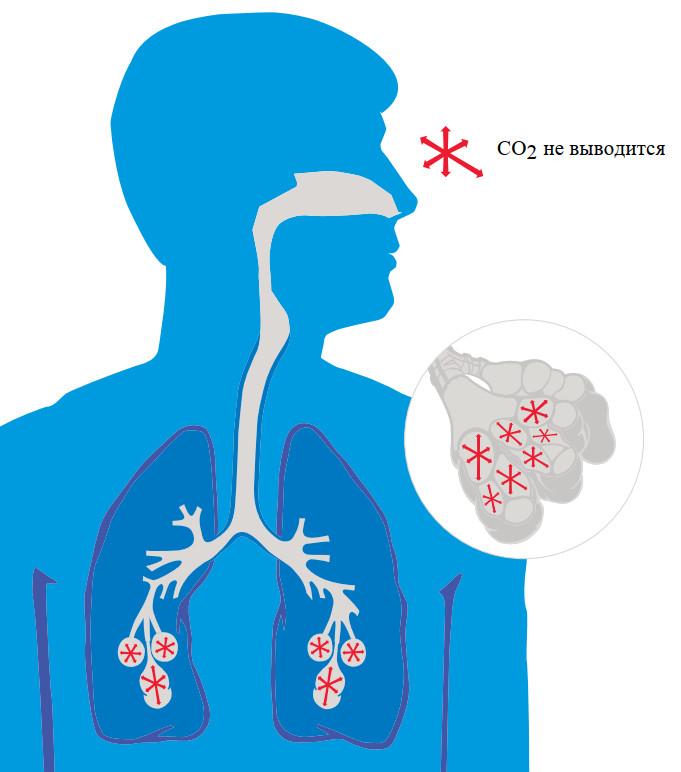 У пациентов с ХОБЛ обструкция или сужение мелких дыхательных путей может привести к задержке в легких СО2 (углекислого газа).