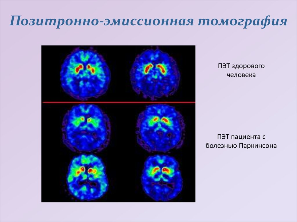 ПЭТ головного мозга позволяет обнаружить у человека с расстройством поведения в фазе быстрого сна изменения метаболизма, характерные для болезни Паркинсона