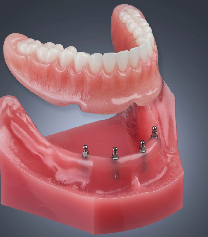 При протезировании зубов человеку с бруксизмом необходимо соблюдать определенные требования