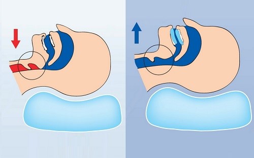 Принцип действия индивидуальной стоматологической капы для сна