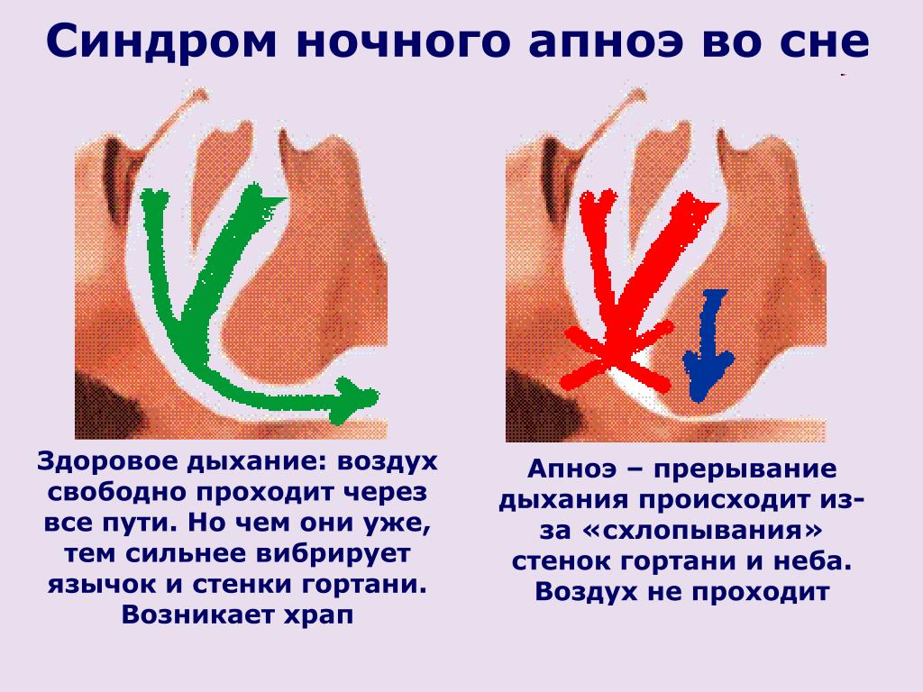 Синдром обструктивного апноэ сна – следствие сужения дыхательных путей и потери тонуса их мягкими тканями