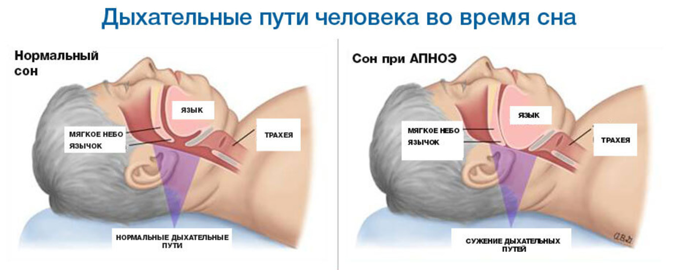 Сужение (обструкция) дыхательных путей у больного с СОАС приводит к затруднению и периодическим остановкам дыхания во сне