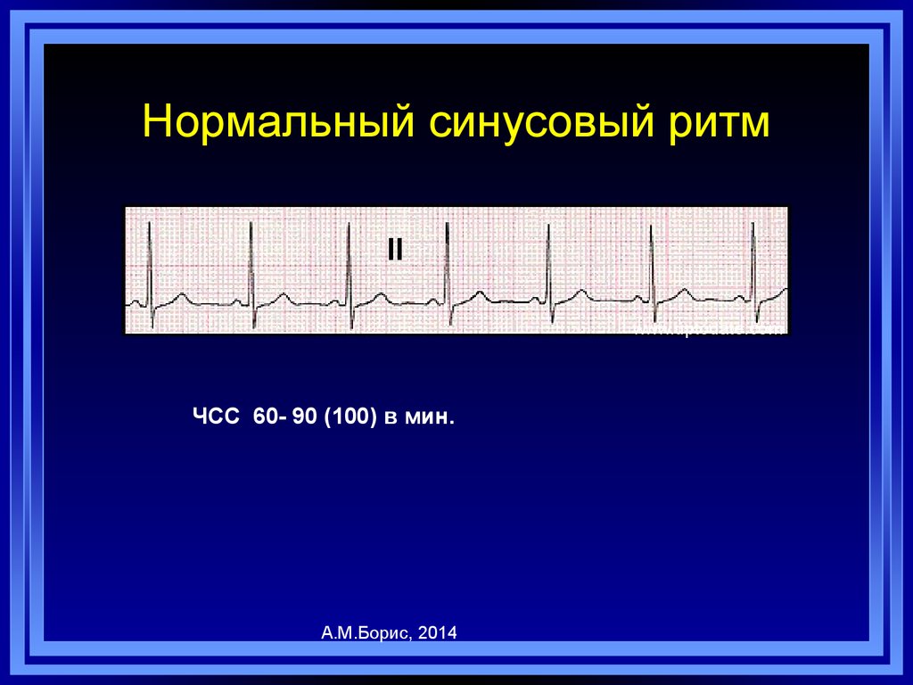 Нарушения сердечного ритма и СОАС – связь, современные подходы к  диагностике и лечению